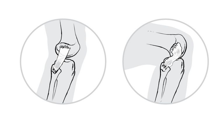 Bei gestrecktem Kniegelenk sind die Seitenbänder gestrafft (links); Bei ge­beugtem Kniegelenk sind die Seitenbänder locker (rechts)
